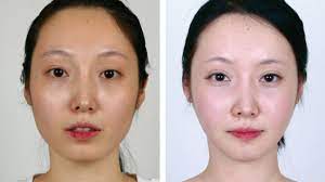 V Line Surgery Cost Procedure And What To Expect