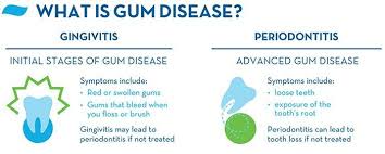 gum disease symptoms causes and treatments crest