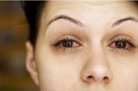 Can Cold Flu And Coronavirus Cause Conjunctivitis All About Vision