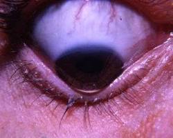 keratoconus cornea shape photo wikipedia, AI generated