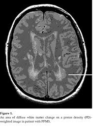 Læger karakteriserer ppms som en form for ms, hvor neurologisk funktion bliver konsekvent værre, uden episoder med tilbagefald eller remission. Magnetic Resonance Imaging In Primary Progressive Multiple Sclerosis