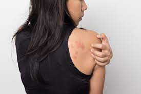 Stress Rash Symptoms Causes Treatments And Coping