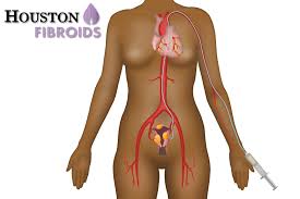 What Is Pelvic Congestion Syndrome Houston Pcs Treatment