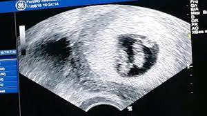 6 week ultrasound pictures twins. 6 Week Ultrasound Its Twins Youtube