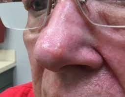 Cailin says the spot would start bleeding, scab, and then go away. Derm Dx Firm Waxy Nodule On The Nose Clinical Advisor