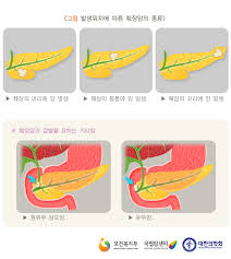 다른 장기로의 전이와 재발을 막기 위해선 수술, 항암제 및 방사선 치료를 포함한 복합적 치료가 핵심인 췌장암. Uniquitous ìžìœ ê²Œì‹œíŒ Free Bulletin Board