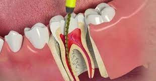 Board Accredited Dentist Reveals Real Truth About Root Canals Root Canal Treatment Root Canal Dental Bridge