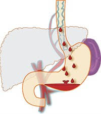 Stage c − the person is not well and their liver function is not good either. Department Of Surgery End Stage Liver Disease Esld