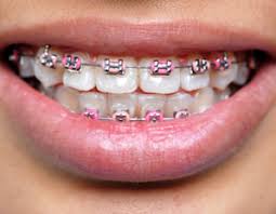 Submerge the mouthguard in boiling water. Brace Yourself Not All Braces Mouthguards Are Created Equally