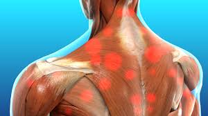 Myofascial Pain Syndrome Mps Successfully Treated Without Surgery