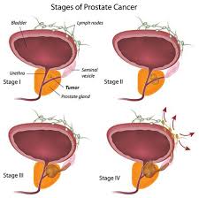 After considering multiple factors, your doctor may recommend. St George Urology Prostate Cancer