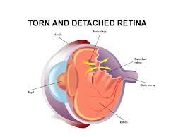 Approximately how much time do patients have to seek treatment before the injury gets worse? Repairing A Detached Retina Florida Eye