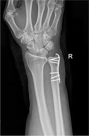 Impaction Syndromes About The Wrist | Current Reviews In Musculoskeletal  Medicine