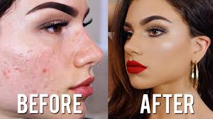 Check spelling or type a new query. 7 Natural Home Remedies To Get Rid Of Pimples The Whistler Nigeria
