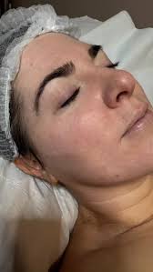 CELLSTORY is a “liquid microneedling”. It uses Microspear® technology:  these are tiny, microscopic needle-like spicules (about 50,000) derived  from freshwater sponges. ￼, These microspears are coated ...