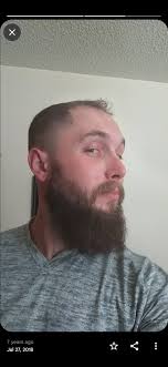 Help with slowing down balding?