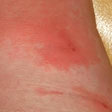 Image result for Erysipeloid