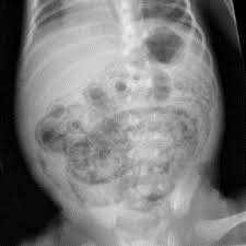 Image result for Necrotizing Enterocolitis