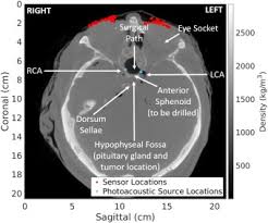As part of the septum nasi (septum nasi) distinguish membranous. Simulations And Human Cadaver Head Studies To Identify Optimal Acoustic Receiver Locations For Minimally Invasive Photoacoustic Guided Neurosurgery Sciencedirect