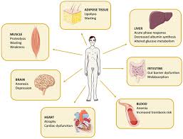 Image result for Cachexia in Cancer
