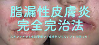 脂漏性皮膚炎 完全完治法