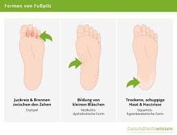 Fusspilz Ursachen Symptome Diagnose Behandlung