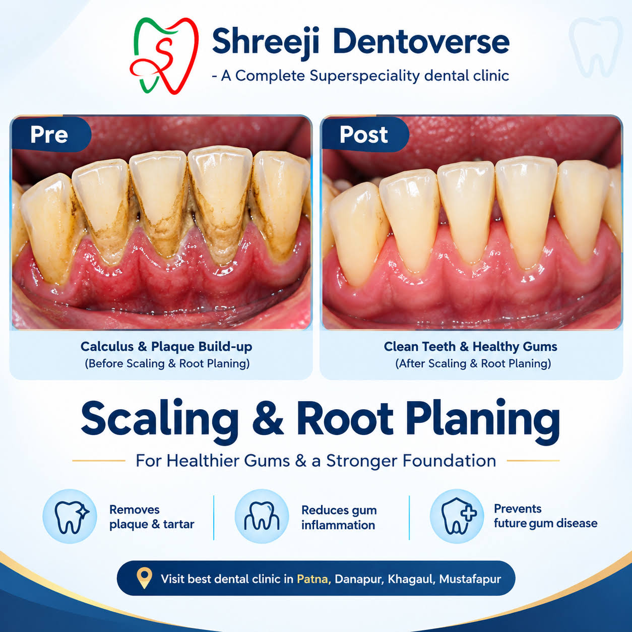 Teeth cleaning / Scaling and root planing. product image