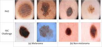 Normal moles don't typically turn into melanoma with 70% of. Example Of Melanoma And Non Melanoma Skin Cancer From Ph2 Database And Download Scientific Diagram
