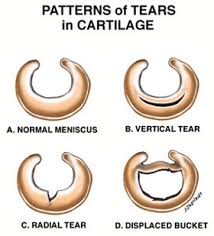It may take weeks or months before you can go back to your daily activities after surgery. Arthroscopy Pinnacle Orthopaedics