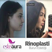Esteaura Burun Estetigi Oncesi Sonrasi Rinoplasti Auralar Estetik