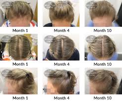 That is typically how long a hair growth cycle takes. Hair Growth Success Story Wonderful Results From This Treatment 9 Months In It Feels Like A Miracle