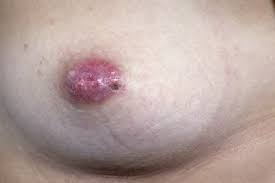 Most rashes are due to allergic reactions to. Paget S Disease Of The Nipple Nhs