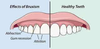 It can cause some serious damage if left unchecked, but not to worry! What Causes Bruxism And Teeth Grinding 3v Dental Associates