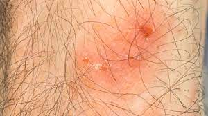 Check spelling or type a new query. Latex Allergy Symptoms And Treatment
