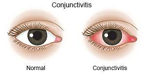 Image result for Conjunctivitis Resources