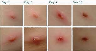 Tanda lelaki sayang kita dalam diam; Chickenpox Sambungan Cikmelankolik