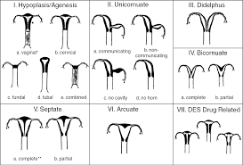mul.le.ri.an adj [fritz muller d. Mullerian Anomaly And Ultrasonographic Diagnosis Chapter 6 Ultrasonography In Gynecology