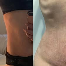 Mtf Corset Training Results Waist Training Mtf Sales