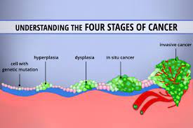 This means that the cancer has spread through the stomach wall, there is some spread to local lymph nodes, but no metastases in other parts of the body. Understanding The 4 Stages Of Cancer