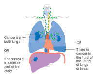 As a rule, the lower the number, the less the cancer has spread. Lung Cancer Wikipedia