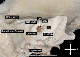 Image result for Temporal Bone