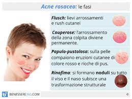 Caratterizzata da papule e pustole simili all'acne giovanile, la rosacea è una patologia dermatologica che è bene trattare fin dagli esordi. Acne Rosacea Cause Cure E Rimedi Naturali Per Le Couperose Al Viso