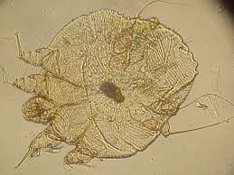Image result for scabies bite