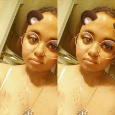 Hi, my name is Tara, I'm 24, and I have NF1; my tumors grow internally.