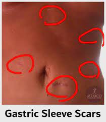 The potential advantages of the sg are that it confers immediate restriction of caloric intake, does not require placement of a. Gastric Sleeve Scars Guide To Reduce Scarring Quickly