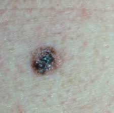 Additional treatment or secondary surgery may be necessary. Melanoma The Most Dangerous Type Of Skin Cancer