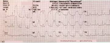 guide to understanding ecg artifact acls medical training