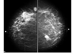 A breast mri captures multiple images of your breast. Bi Rads 5 Cc Mammography Showing The Right Breast Tumor Download Scientific Diagram