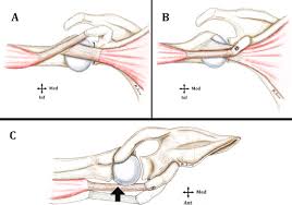 The muscles and tendons of the rotator cuff form a sleeve around the anterior, superior, and posterior humeral head and glenoid cavity of the shoulder by compressing the glenohumeral joint. Arthroscopy Assisted Trillat Procedure For Anterior Shoulder Instability Surgical Technique And Preliminary Clinical Results Sciencedirect