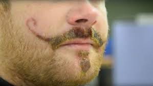 This process can help you out as well. Henna Tattoo Allergy Leaves Man With Potentially Permanent Handlebar Mustache Scar